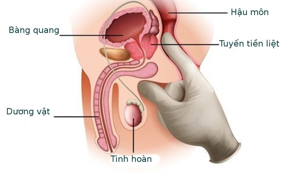 Phòng ngừa ung thư tuyến tiền liệt ở nam giới