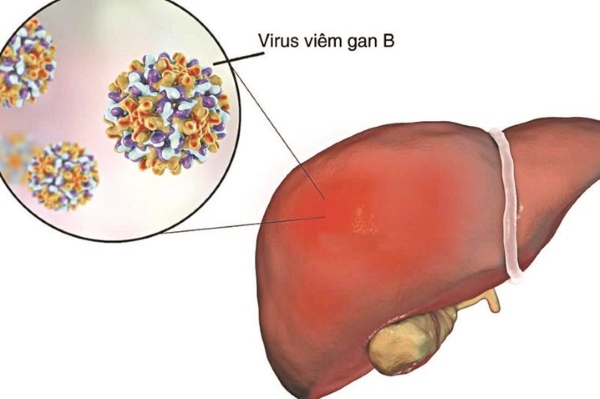 Viêm gan B