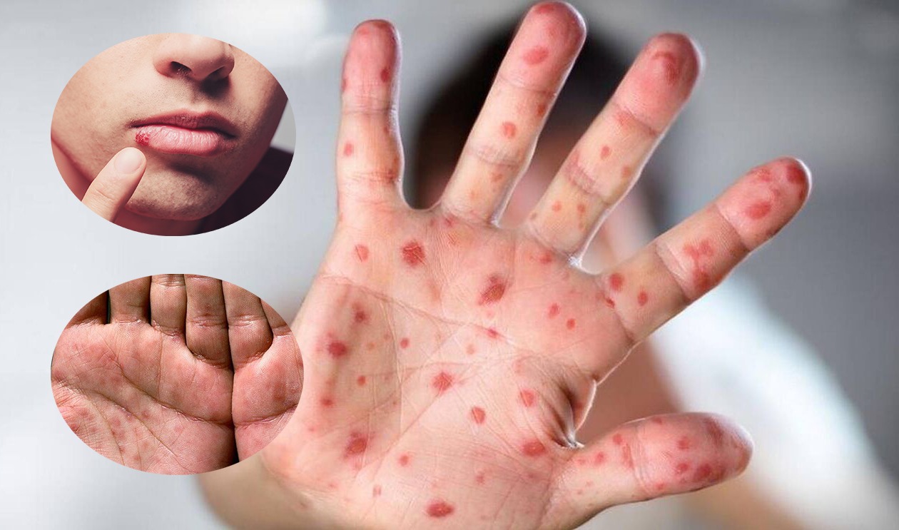 Nhóm bệnh lây nhiễm qua đường da và niêm mạc